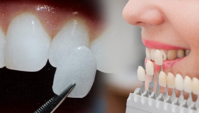 Mặt dán sứ Veneer không mài răng – Giải pháp hoàn hảo cho hàm răng khuyết điểm